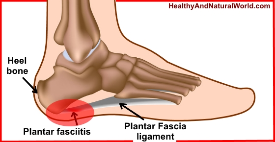 Natural Remedies for Plantar Fasciitis (Jogger’s Heel)