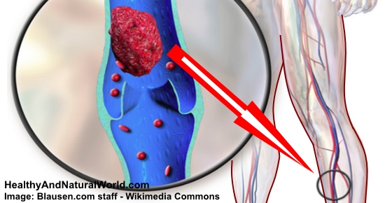 Deep Vein Thrombosis: A Silent Killer That You Need to Know