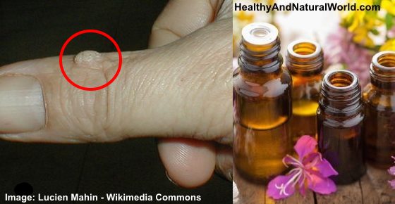 The Best Essential Oil for Treating Warts Naturally