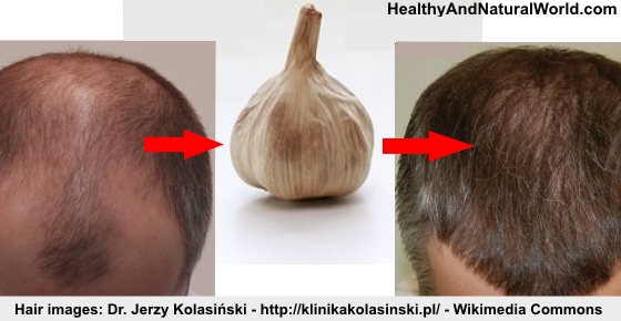 How to Use Garlic to Promote Hair Growth (Research Based)