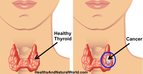 1 Minute At Home Thyroid Cancer Self-Test: This Can Save Your Life