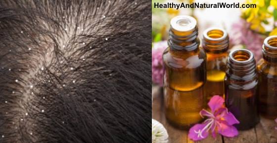 The Best Essential Oils to Get Rid of Dandruff