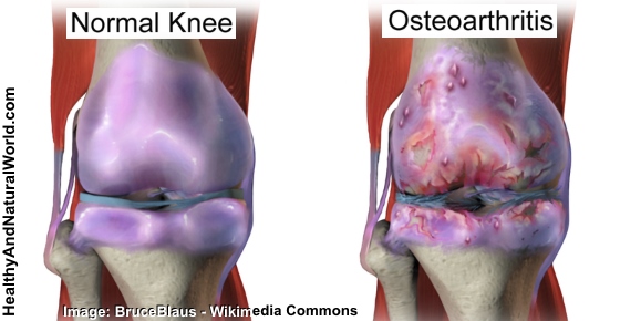 Knee Osteoarthritis Proven Remedies