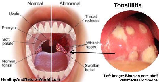 The Best Home Remedies for Tonsillitis