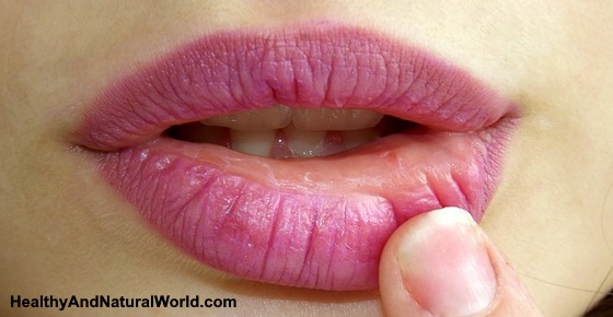 Home Remedies for Chapped Lips