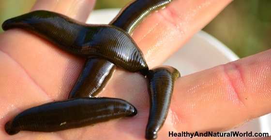 The Health Benefits of Medicinal Leech Therapy