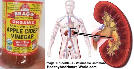 How to Use Apple Cider Vinegar (ACV) for Kidney Stones