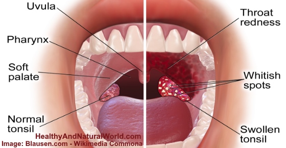 White Spots on Throat - 6 Common Causes (Images Included)