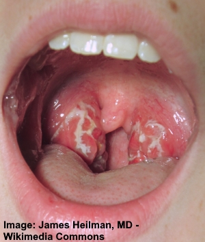 Strep throat can cause white spots on throat