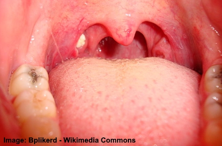 Tonsil stones - white dots on back of throat