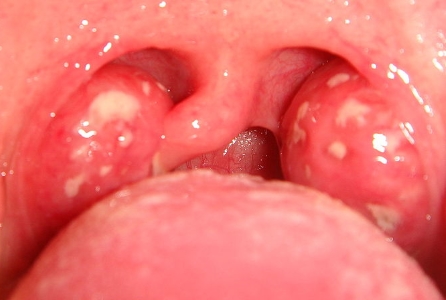 Tonsillitis can cause white spots on tonsils