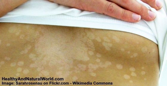 White Spots on Skin – Causes and Possible Treatments
