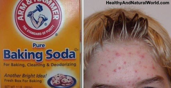 Baking Soda for Acne and Pimples - The Complete Guide