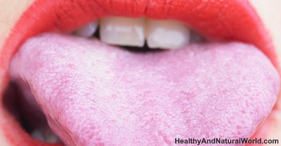 Bumps on Tongue – Causes and Natural Treatments