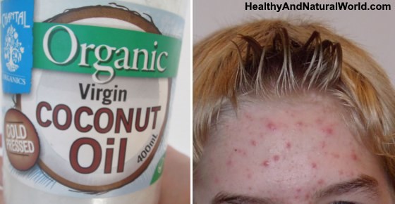 Coconut Oil For Acne - Does It Really Work?