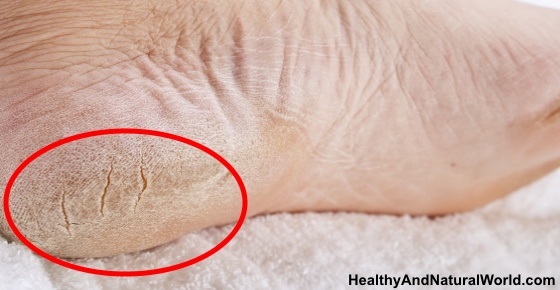 How to Get Rid of Dead Skin on Feet, Dry Feet and Cracked Heels