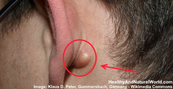 Lump Behind Ear - Causes and Treatments