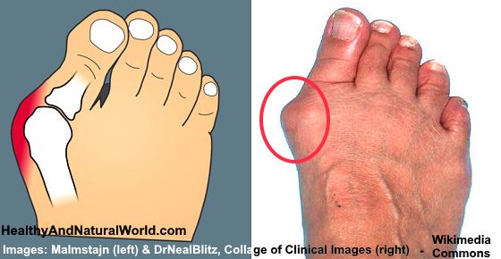 How to Get Rid of Bunions Naturally