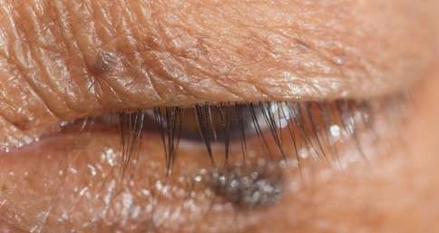 skin tags on eyelids betadine skin tags on eyelids betadine
