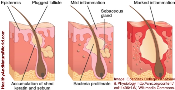 How to Get Rid of Blind Pimples