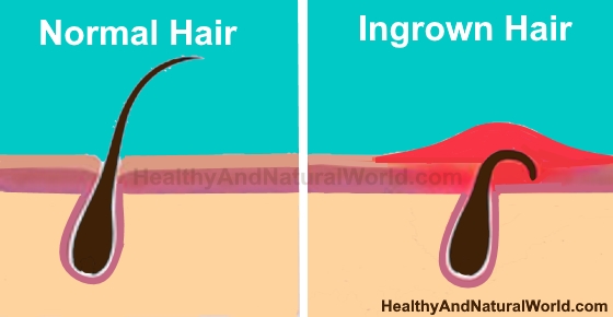How to Get Rid of Ingrown Hair
