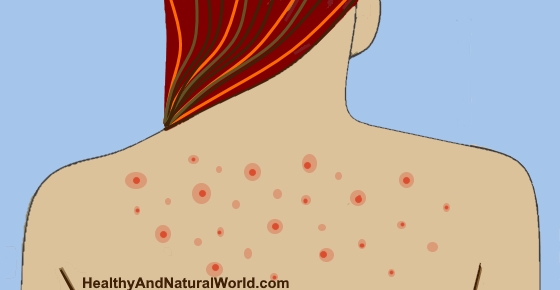 How to Get Rid Of Back Acne (“Bacne”)