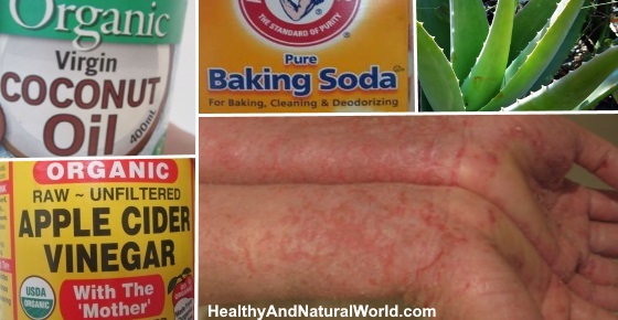 How To Get Rid Of Eczema: 13 Natural Remedies Backed By Research