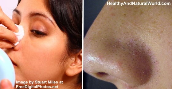 How to Get Rid of Blackheads Quickly and Naturally