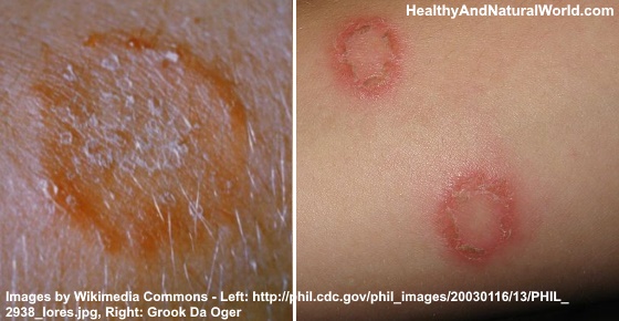 How to Get Rid Of Ringworm - The Best Home Remedies (Based on Research)