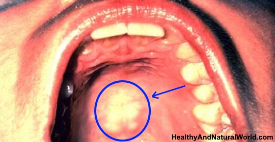 Irritated Roof Of Mouth