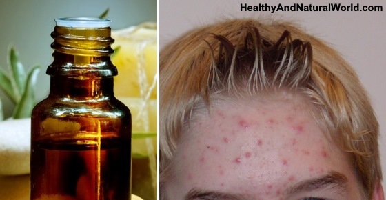 How to Use Tea Tree Oil for Acne: The Ultimate Guide