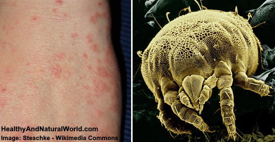 Mite Bites: Common Symptoms and Natural Treatments