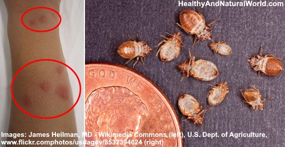 How to Get Rid of Bed Bug Bites - The Best Home Remedies