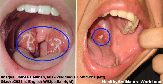 White Spots on Tonsils: 7 Common Causes and Effective Treatments