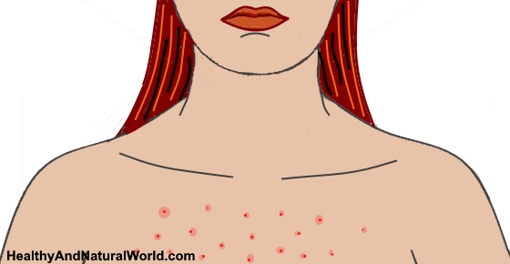 How to Get Rid of Chest Acne: The Most Effective Natural Ways