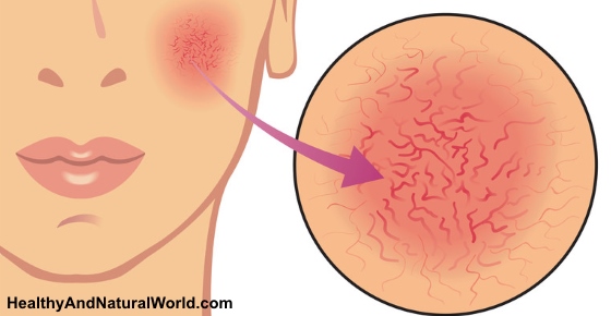 Broken Blood Vessels on Face - Causes, Symptoms and Treatments