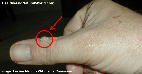 warts on hands recurring)