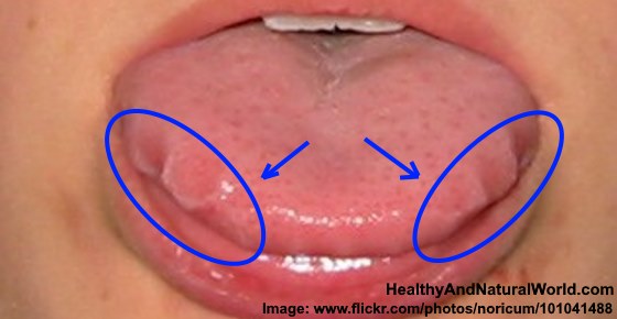 What Causes Scalloped Tongue (Wavy Tongue) and How to Get Rid of It