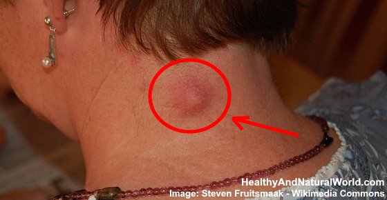 How to Get Rid of a Sebaceous Cyst Naturally