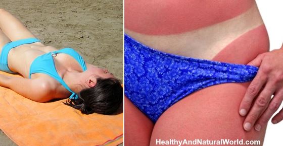 How Long Does It Take for a Sunburn to Heal?