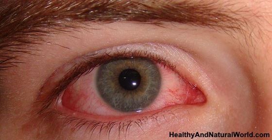 Home Remedies for Eye Infection that Actually Work