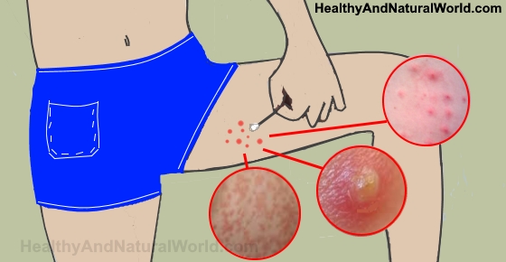 Effective Ways To Get Rid Of Bumps On Inner Thigh Backed By Science.