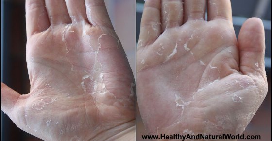 Peeling Skin on Hands or Fingers: Causes and Treatments