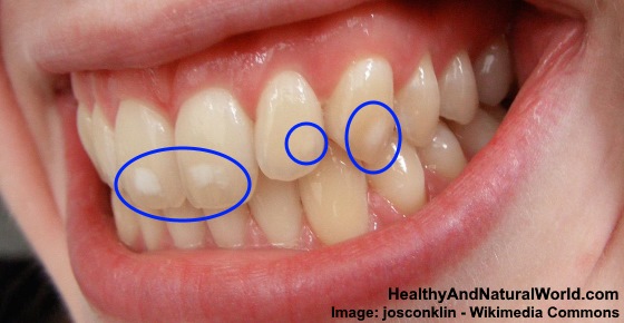 White Spots on Teeth: Causes and Treatments
