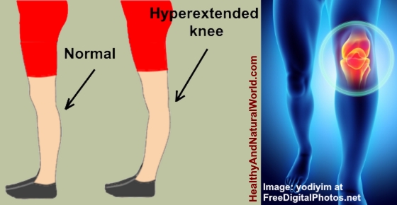 Hyperextended Knee: Causes, Treatments & Prevention