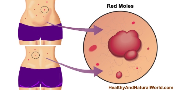 What Causes Red Moles on Skin and How to Get Rid of Them