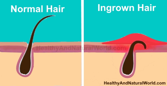 How to Get Rid of Ingrown Hair on Head