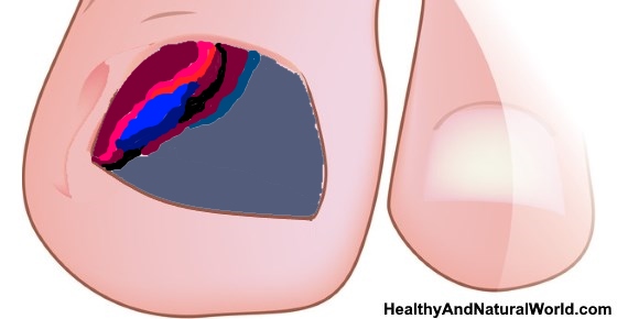 Bruised Toenail: Causes, Symptoms and Effective Treatments