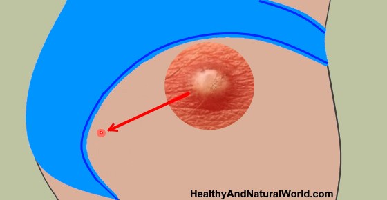 Cyst Treatment, Removal, Types Symptoms