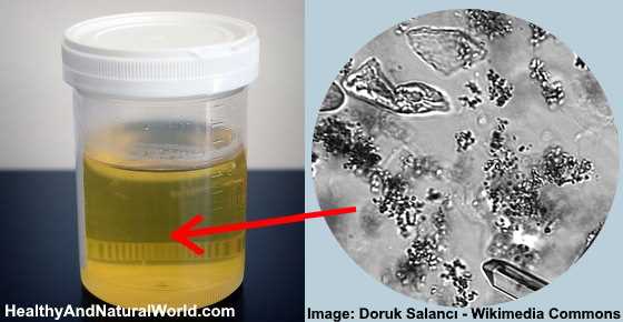 Squamous Epithelial Cells in Urine